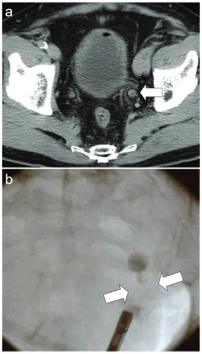 Figure 1. Radiological images of the ureteral tumor. onstrating the tumor in the lower portion of the left ureter (arrow)