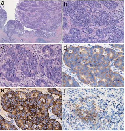 Figure 4. Photomicrographs of the ureteral tumor. A: Low-power view of neoplastic cells in irregularly shaped nests fine or coarse granular hyperchromatic material and nuclei and moderately enlarged nucleoli
