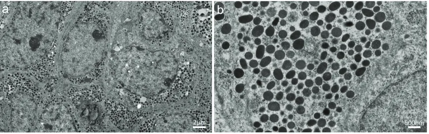 Figure 5. Transmission electron micrographs of the ureteral tumor. A: Neoplastic cells harboring abundant dense granules in a relatively rich cytoplasm (the scale bar indicates 2 µm)