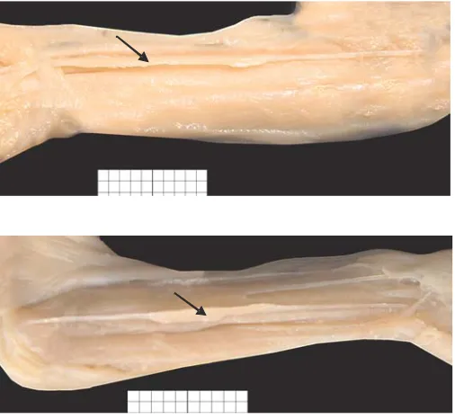 Fig. 13. Anomalies in photograph: a) palmarislongus muscle inversion, the belly is situated inthe forearm’s distal segment; b) in the mid forearm