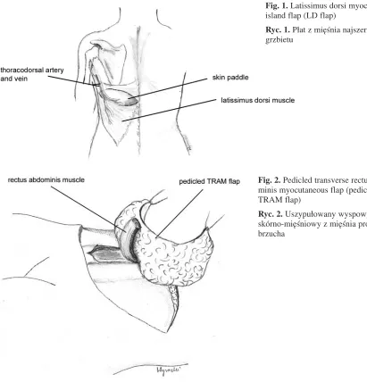Fig. 1. Latissimus dorsi myocutaneous