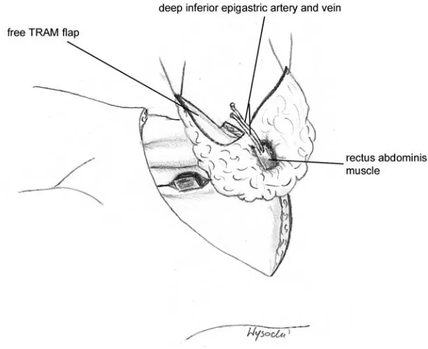 Fig. 1. Free transverse 