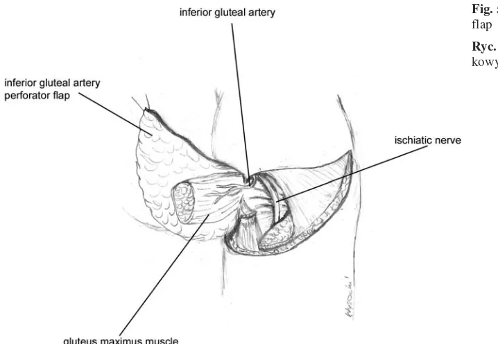 Fig. 5. Free interior gluteal