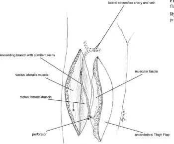 Fig. 6. Anterolateral thigh