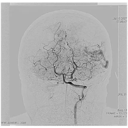 Fig. 4. Before embolization