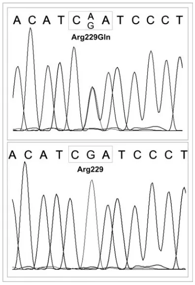 Fig 1. Mutational analysis of sequences and flanking region) with heterozygousR229Q (Arg229Gln) mutations in exon 5 (upperpanel) compared with the normal gene sequenceNPHS2 (5’UTR, coding(lower panel)