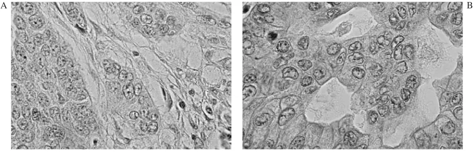 Fig. 1. A. Negative immunostaining of nm−23 protein. B. Positive immunostaining of nm−23 protein