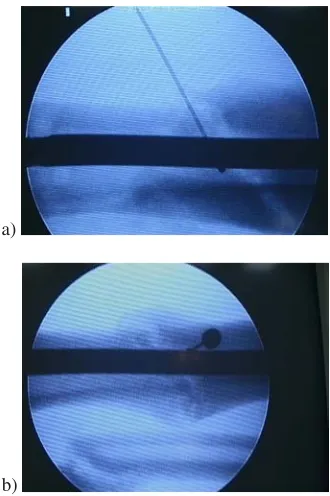 Fig. 1. Patient T.Z., age 30, disease history no.7647/05, tibial bone. Percutaneous bone marrow graft−ing: a) injection into delayed union, b) injectionaround delayed union