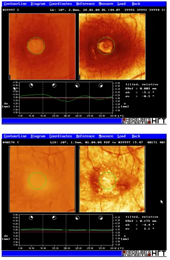 Fig. 1. Scanning lasertopography of the macularhole before vitrectomy