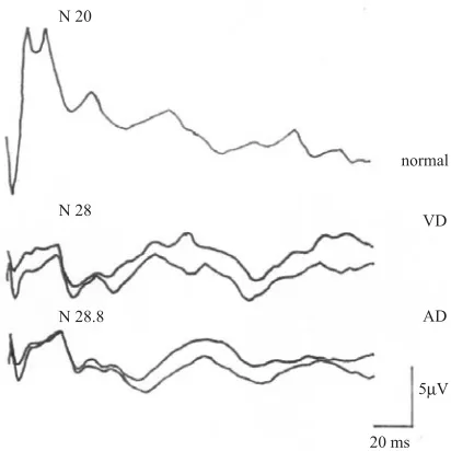 Fig. 1. N20 latency of the cortex response of SSPE inpatients with VD and AD and in the control grouprecorded heterolaterally