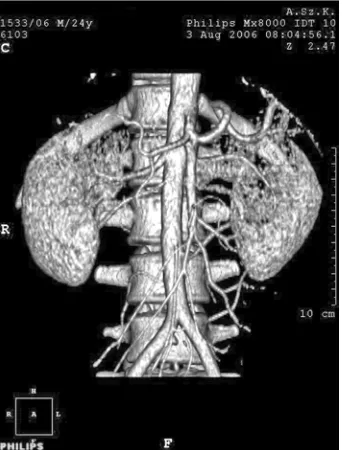 Fig. 4. Maximum intensity projection image of bilater−al duplication of renal arteries with the right additionalartery originating close to the major right renal arteryand the left renal artery arising much more distally, atthe level of the inferior mesenteric artery