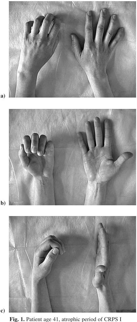 Fig. 1. Patient age 41, atrophic period of CRPS I– compulsory position of left arm: a) dorsal image ofboth hands, b) palmar image of both hands, c) lateralimage of both hands