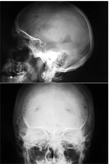 Fig. 3. Skull X−ray on the 4th day of hospitalization  –note the pneumocephalus