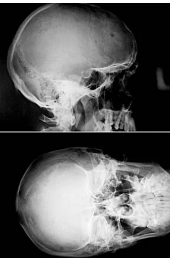 Fig. 5. Follow−up X−ray made two weeks after dis−charge from the hospital shows no pathologies
