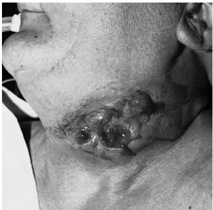 Fig. 2. Intraoperative picture after neck dissection withpectoralis myocutaneous flap prepared for dislocation