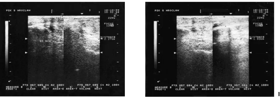 Fig. 2. A. Bunuel’s method, post−suturing condition of the left lower limb Achilles tendon in a 54−year−old female ata distance of 1.8 cm from the tuber of the calcaneal bone