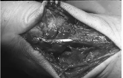 Fig. 15. The use of fibrin glue in microsurgical nervereconstruction