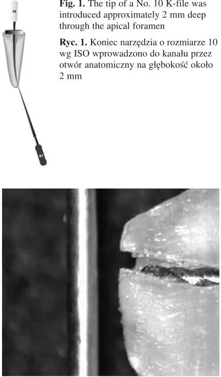 Fig. 1. The tip of a No. 10 K−file was