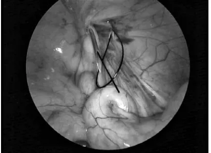Fig. 2. Intraoperative view: The needle passes throughthe medial half of the inguinal ring
