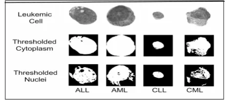 Figure 1. Four different forms of Leukemia undergo Biomodal thresholding. 