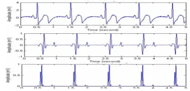 Figure 2.Proposed ECG Detector