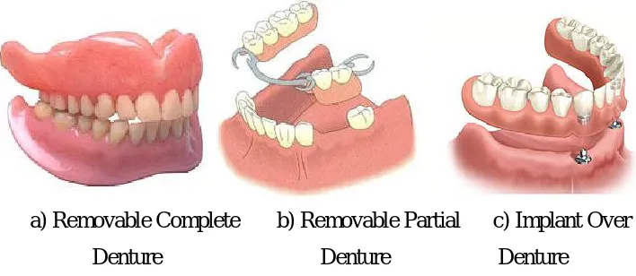 Figure 2.1:  Types of denture (Deadwood, 2008) 