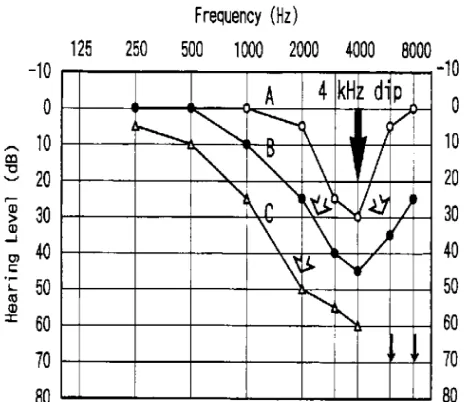 Figure 2.4: Hearing threshold shift (Audiometry) 