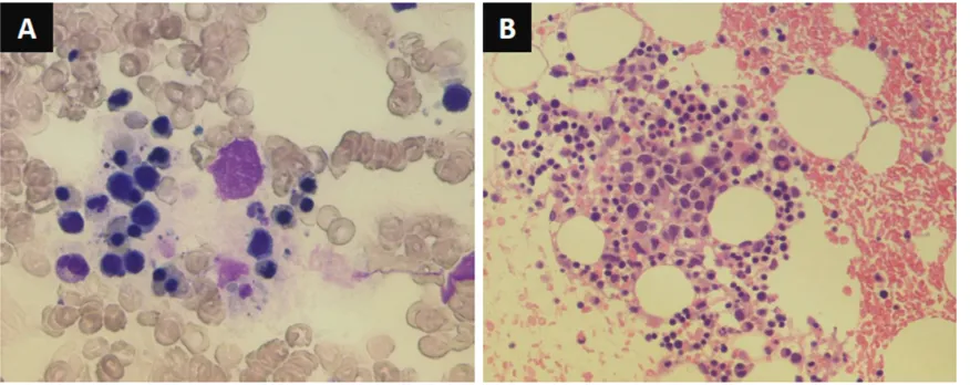 Figure 1. Hematoxylin-eosin stain of bone marrow aspiration showing increased phagocytic cells (A)