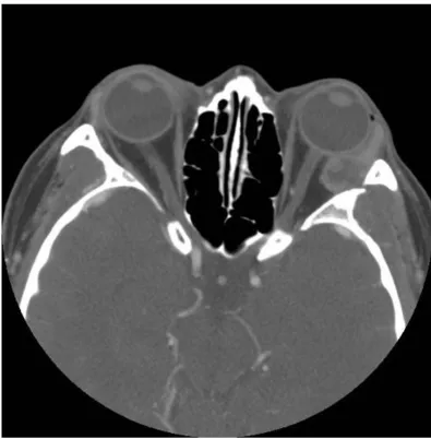 Figure 1without bone involvementContrast-enhanced axial orbital computed tomography showing a well-circumscirbed mass at lateral aspect of the left orbit Contrast-enhanced axial orbital computed tomography showing a well-circumscirbed mass at lateral aspect of the left orbit without bone involvement.