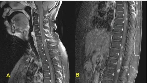 Figure 4and clivusFollow-up brain MR images revealing a slightly decreased tumor size extending to orbital, cavernous sinus, infratemporal fossa, Follow-up brain MR images revealing a slightly decreased tumor size extending to orbital, cavernous sinus, inf