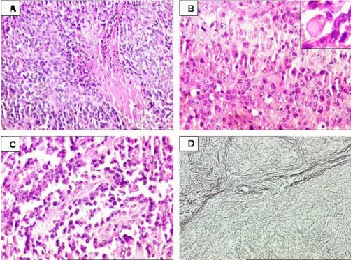 Figure 2Proximal-type epithelioid sarcoma of perineumProximal-type epithelioid sarcoma of perineum