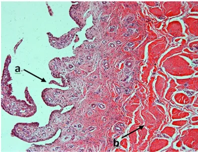Figure 3. A, B. Synovial IL-17 immunohistochemical staining of healthy people and RA patients (brownish yellow color).