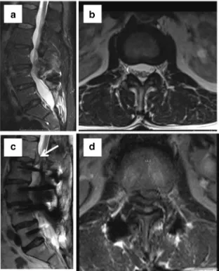 Fig. 14 Status post L2–L5fusion. Worsening ofdegenerative changes with discextrusion at the level just abovefusion at L1–2 (c and d)compared to initial images done ayear earlier (a and b)