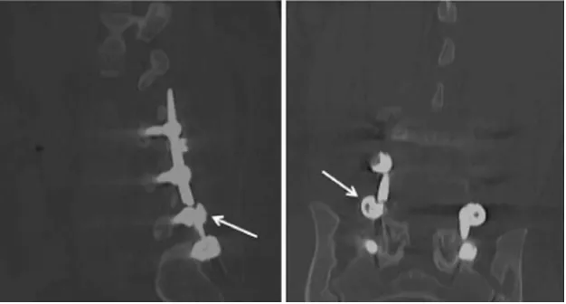 Fig. 7 Sagittal and coronal CTreformats. Fracture of the verticalfusion rod with persistentanterolisthesis