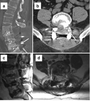Fig. 10 Pseudoarthrosis with lack of bony fusion on CT (b and d) and persistent increased signal on STIR and T2 WI (a and c) with worseninganterolisthesis