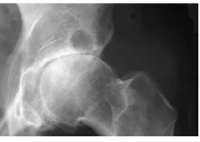 Figure 4. Bony swellings due to OA