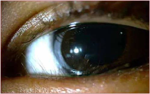 Figure 6: Trichiasis (in-turned eyelashes) is associated with trachoma