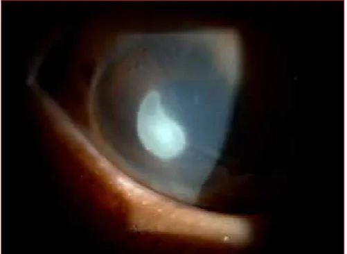 Figure 8: Vernal keratoconjunctivitis: limbal type