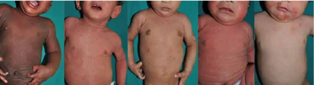 Table 1. Categories of atopic dermatitis9,10