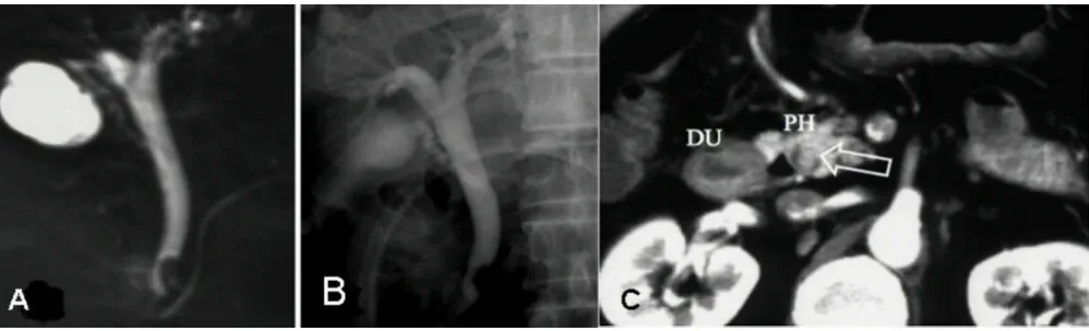 Figure 1Cholangiographies: A and B)Cholangiographies: A and B). Endoscopic retrograde cholangiopancreatography (ERCP) and C)