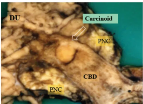 Figure 2ductfrom the surface of the intra-pancreatic portion of the bile mass (arrow), measuring 1.0 × 1.2 × 0.7 cm in size, projecting The surgical specimen showed a golden yellowish polypoid The surgical specimen showed a golden yellowish polypoid mass (