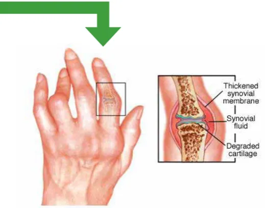 Figure 2. a&c: A normal joint and its changes in RA18 Normal joint; b&d: Joint with established RA