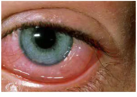 Figure 1: Allergic conjunctivitis 