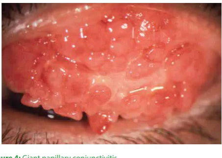 Figure 4: Giant papillary conjunctivitis 
