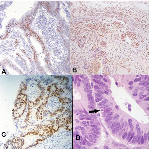 Figure 1A) p21 expression in adjacent tumor tissueA) p21 expression in adjacent tumor tissue