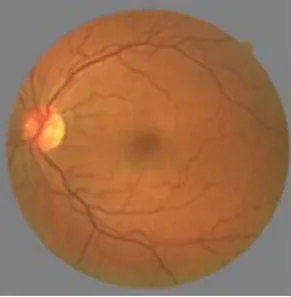 Figure 1: Retinal image 