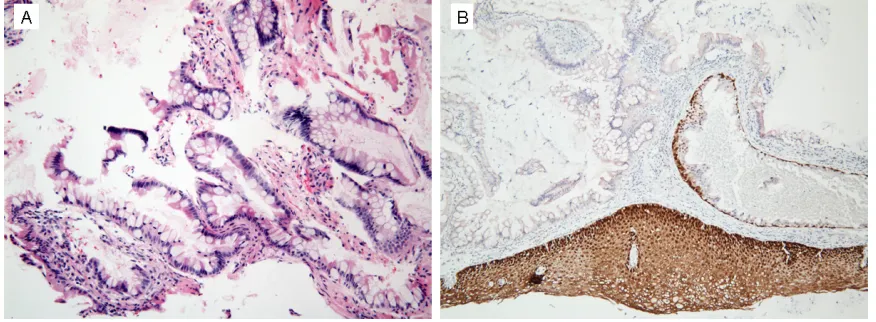 Figure 2. A: H&E shows an area of bland appearing intestinal-type metaplasia; B: Ki-67 immunostain shows focally increased proliferation.