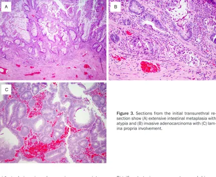 Figure 3. Sections from the initial transurethral re-section show (A) extensive intestinal metaplasia with 