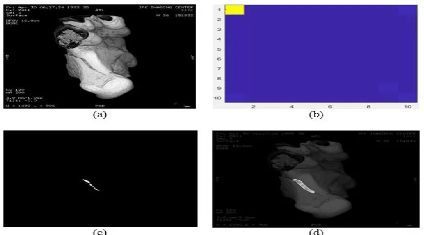 Fig. 5. Results on the CT Image. (a) original image, (b) GLCM, (c) binary mask, (d) segmented image