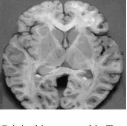 Table I:  Brain image results with the varying Huffman quantization factor at DWL level as 2.